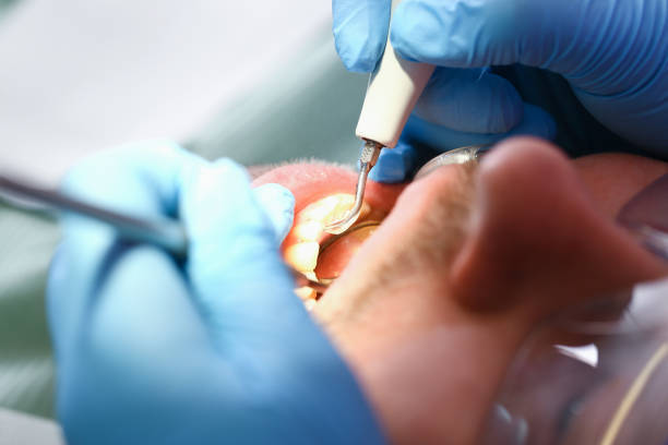 Best Emergency Root Canal Treatment in Lake Holiday, IL