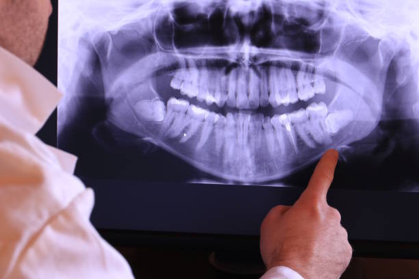 Best Emergency Dentist for Lost Fillings or Crowns in Lake Holiday, IL