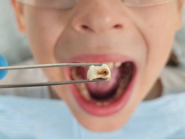 Best Broken or Cracked Tooth Emergency Dentist in Lake Holiday, IL